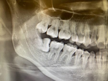 Impacted Wisdom Tooth Extraction