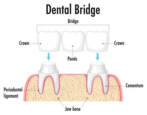 Infographic of human in dental bridge on white background illustration